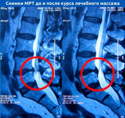 Снимки МРТ до и после курса лечебного массажа